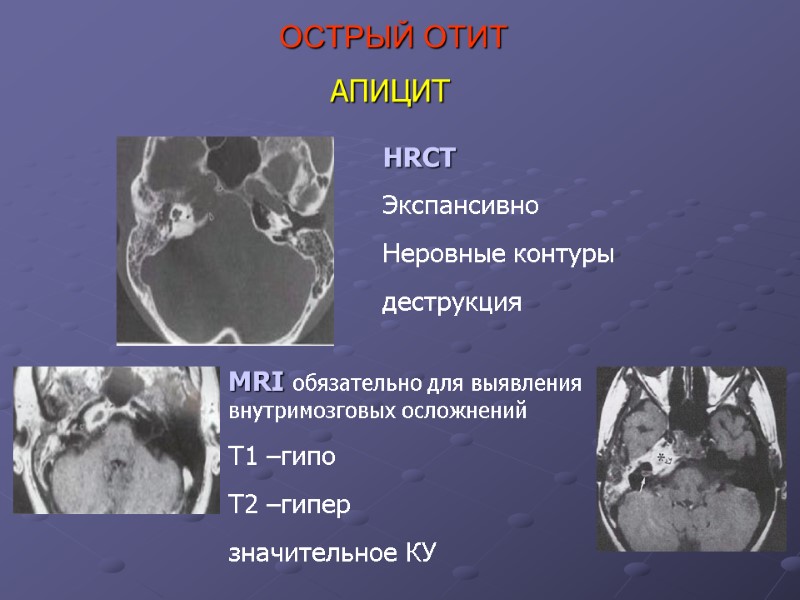 АПИЦИТ HRCT Экспансивно Неровные контуры деструкция MRI обязательно для выявления внутримозговых осложнений T1 –гипо